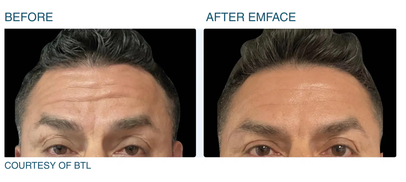 Emface Before and After Pictures