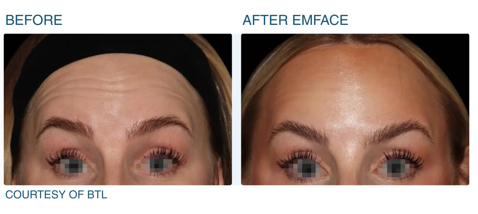 Emface Before and After Pictures