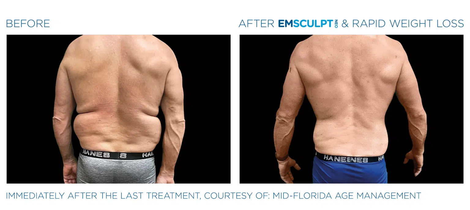 Emsculpt NEO Before and After Photos