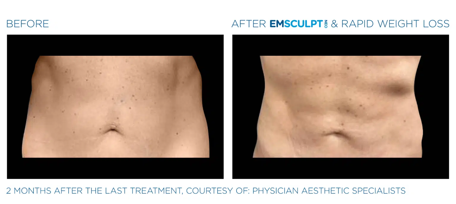 Emsculpt NEO Before and After Photos