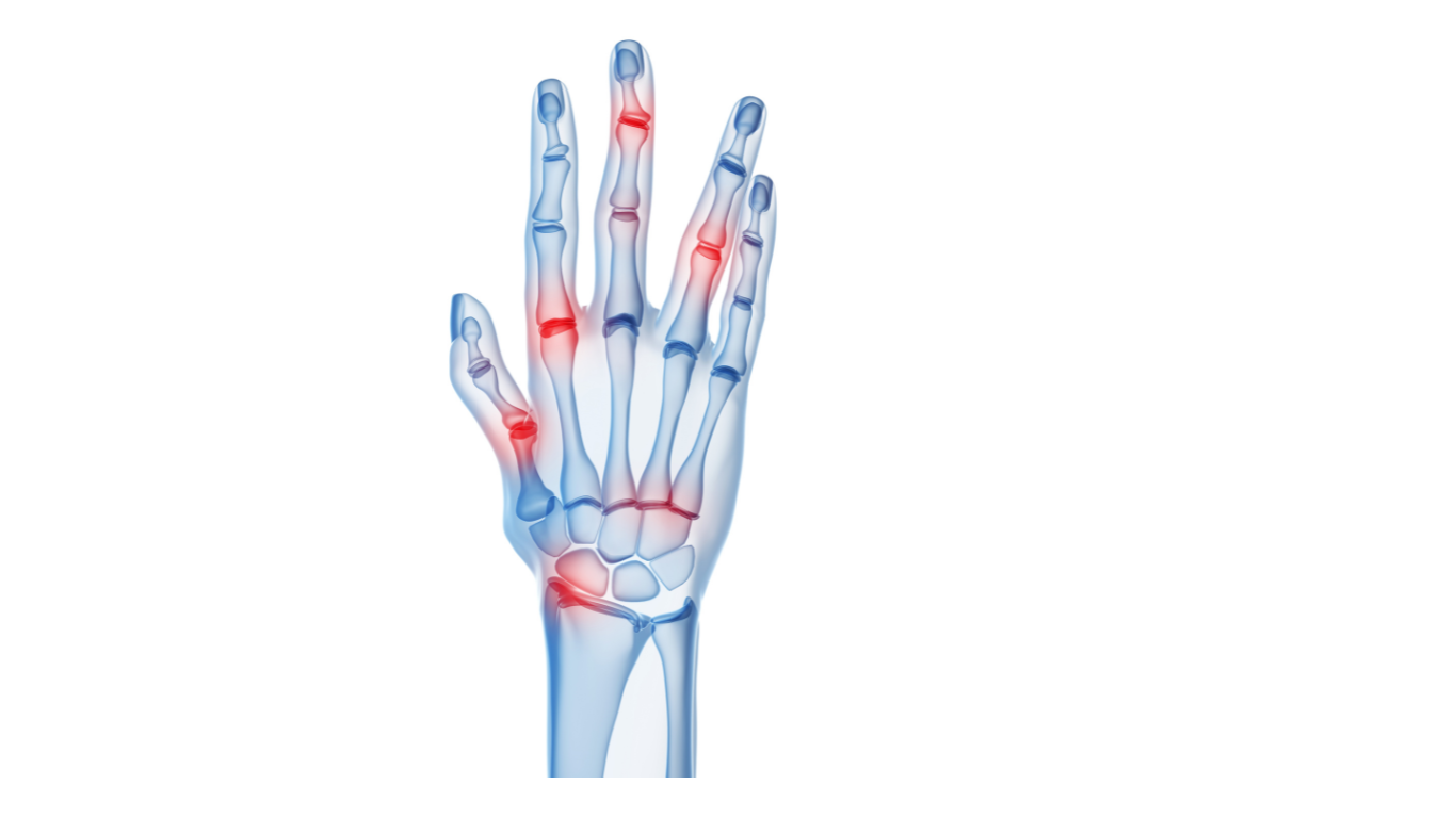 Arthritis differences