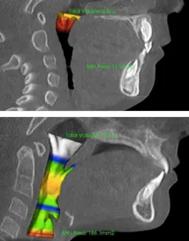 Tongue Tie Therapy