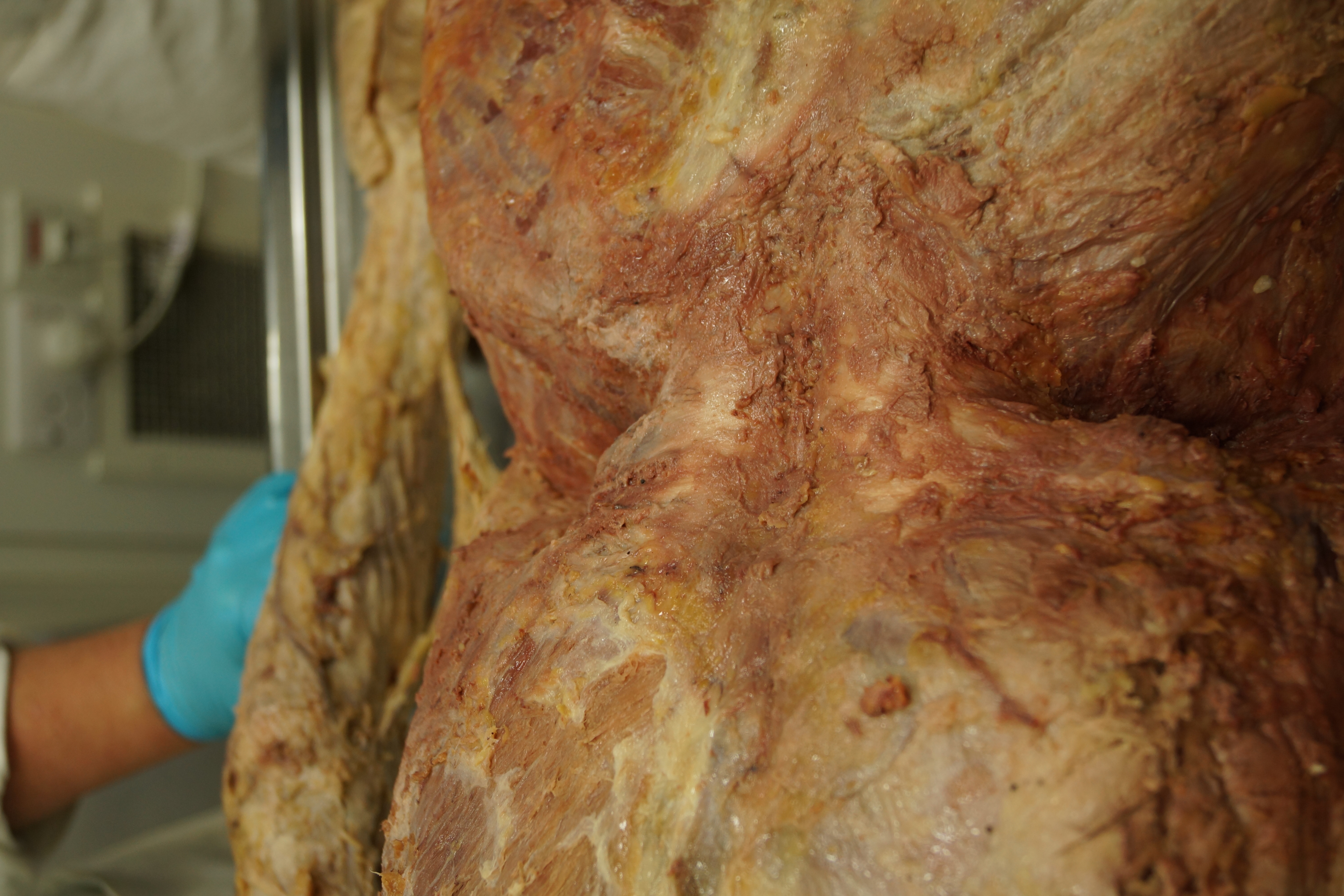 Dissection of lumbar spine showing thick thoracolumbar fascia Dissection of lumbar spine showing thick thoracolumbar fascia