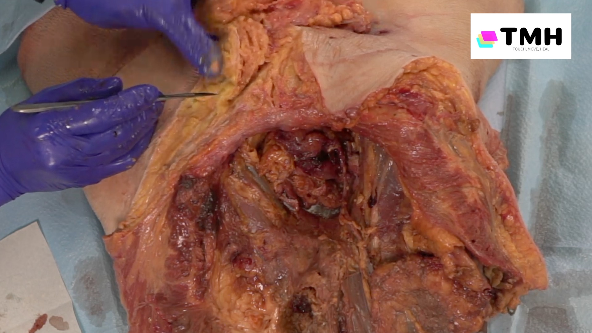Pelvis dissection Pelvis dissection
