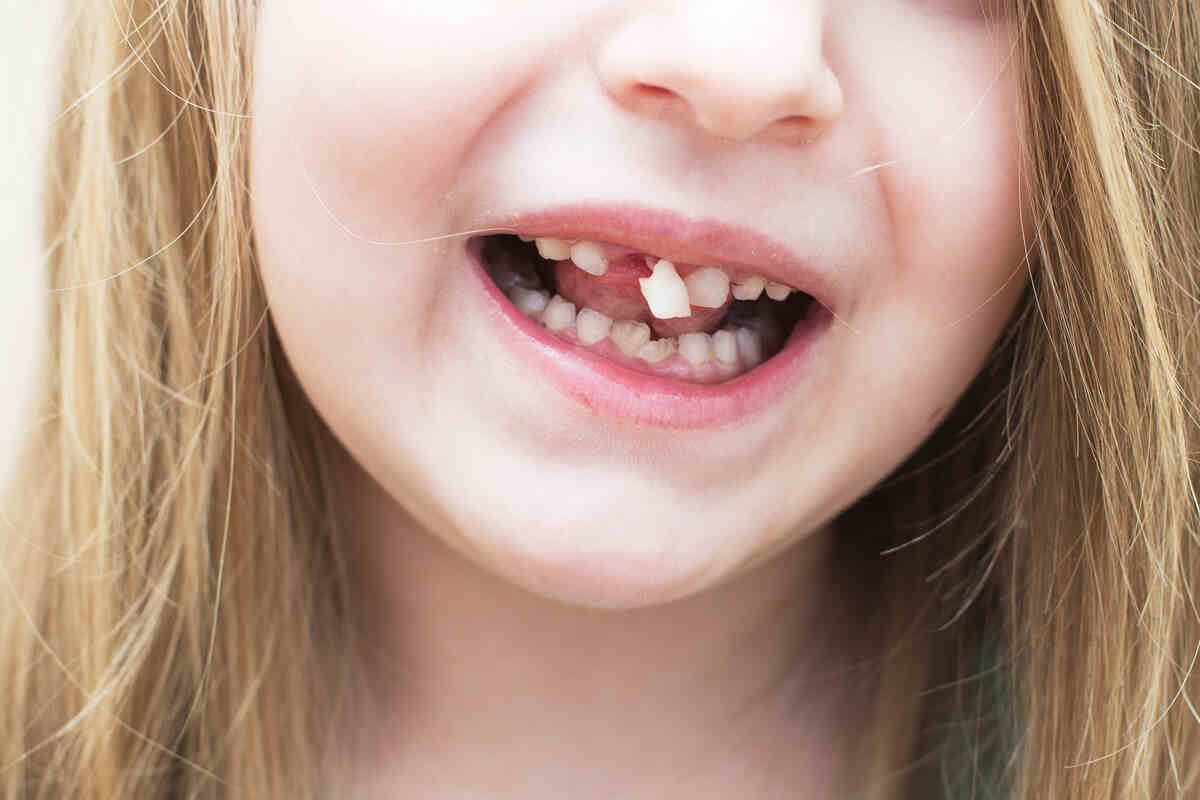 Kids-dental-emergencies-caused-by-knocked-out-or-chipped-teeth Kids-dental-emergencies-caused-by-knocked-out-or-chipped-teeth