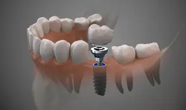 Dental Implants