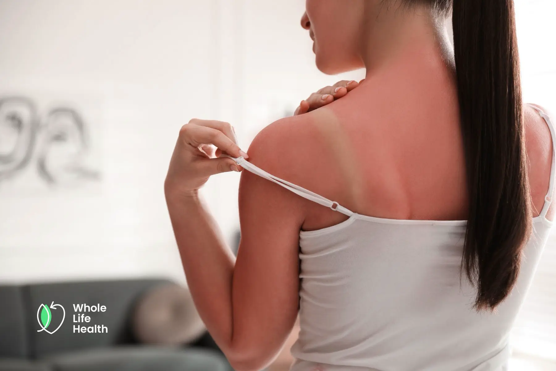 sunburn sunburn