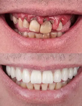 Smile Makeover Snap on Denture