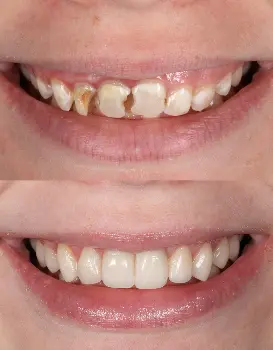 Smile Makeover