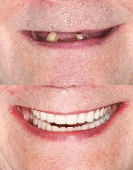 Smile Makeover Fixed Denture