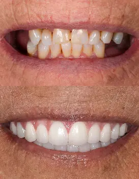 Smile Makeover Overdenture