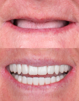 Smile Makeover Single Implants