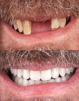 Smile Makeover Permanent Denture