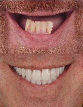 Smile Makeover Implant Denture