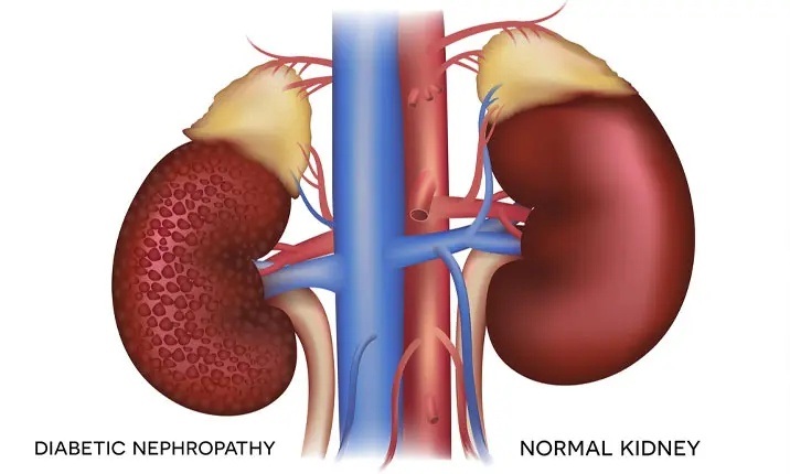 Effected Diabetic Kidney Effected Diabetic Kidney