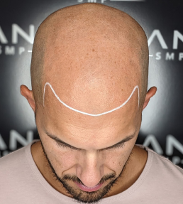 Men Baldness