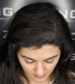Female_Hair_Loss