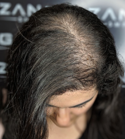 Female_Hair_Gain
