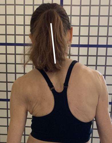 neck pain with scoliosis