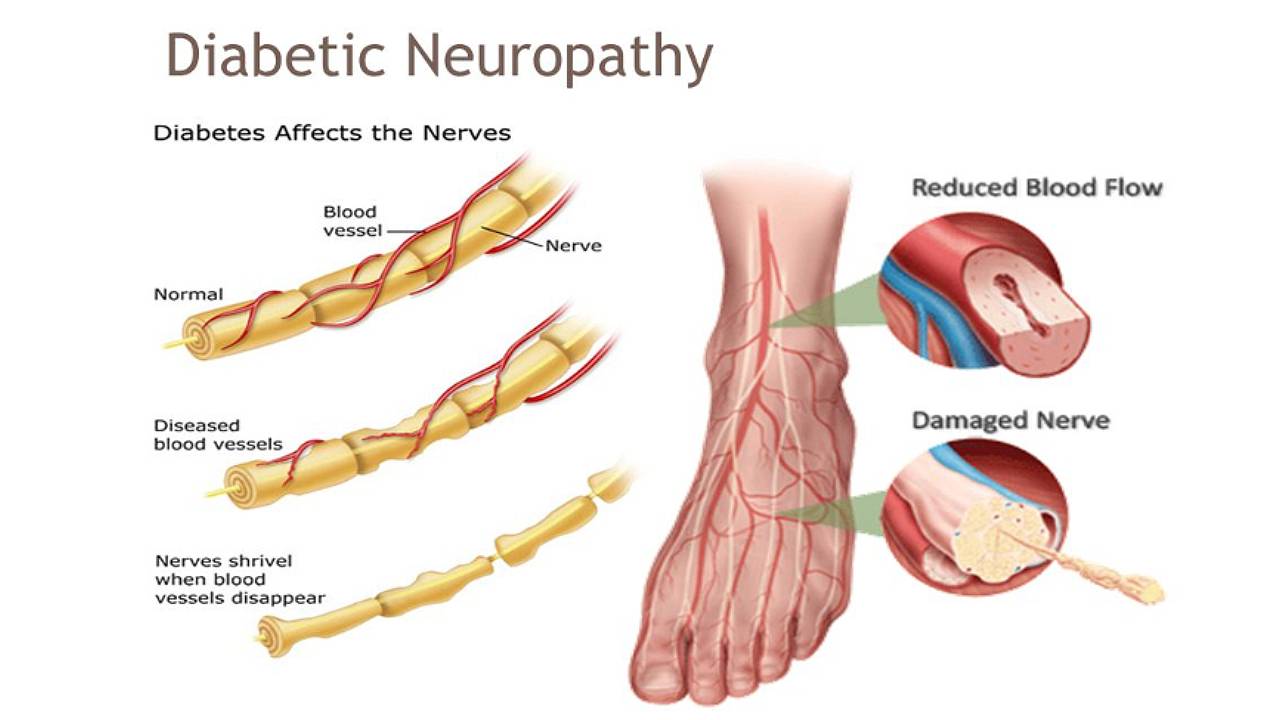 Diagram illustrating diabetic neuropathy, showing the effects of diabetes on blood vessels and nerves. The image highlights the stages of normal blood vessels, diseased blood vessels, and the damage caused when nerves shrink as blood vessels disappear, affecting blood flow and nerve function in the foot.