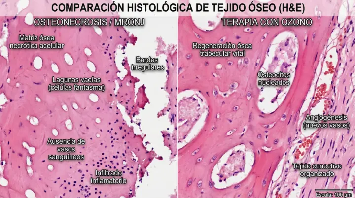 Comparación histológica de cicatrización ósea en maxilares tratados con ozono sistémico vs control con bisfosfonatos