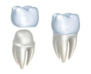same day dental crown and tooth