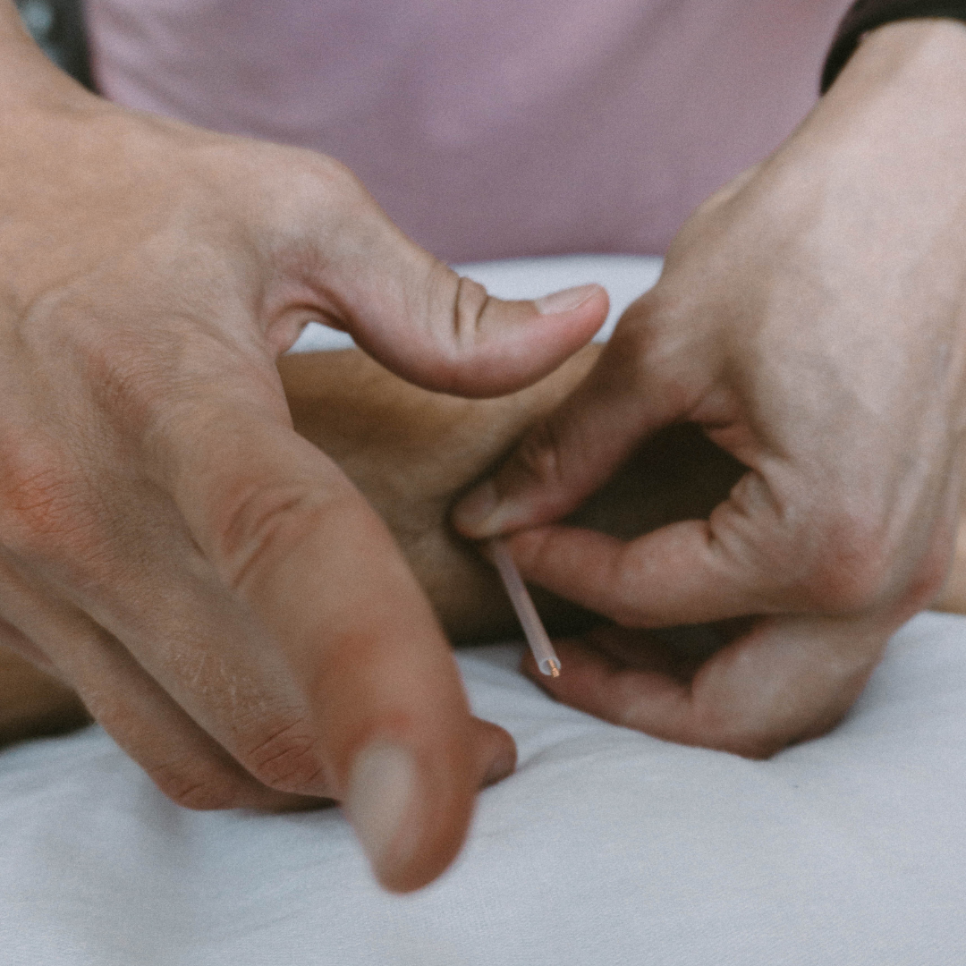 Insertion of an acupuncture needle for IMS on a Physiotherapy client Insertion of an acupuncture needle for IMS on a Physiotherapy client