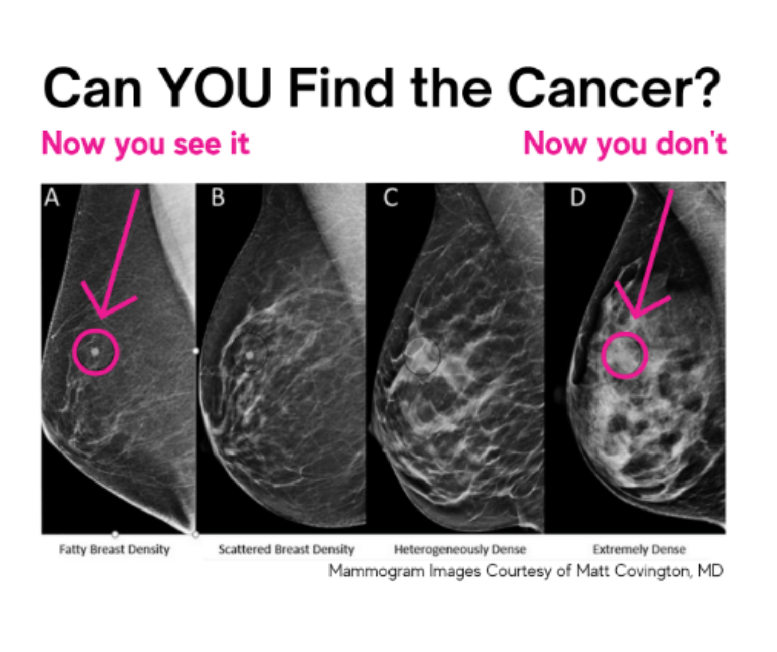 Can You Find the Cancer? Image