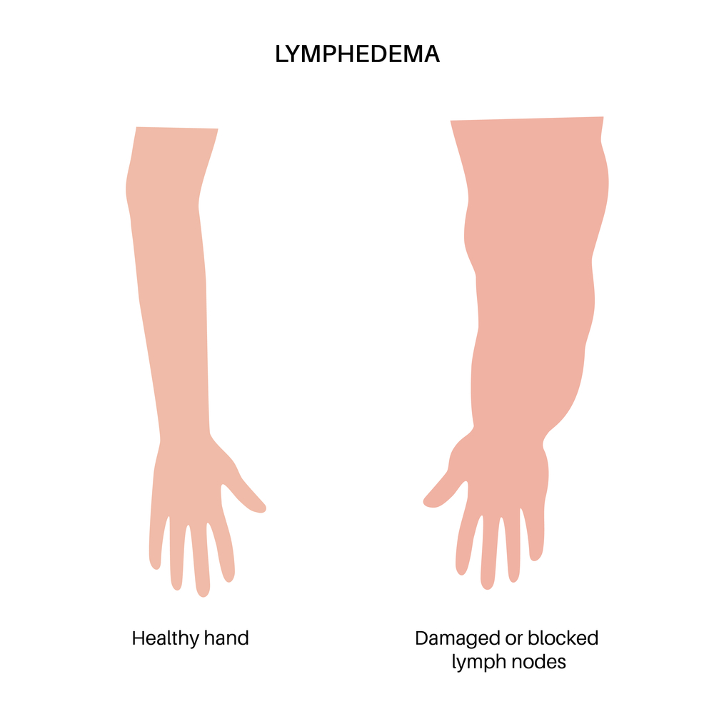 Lymphedema After Breast Cancer Frequency Incidence And What Increases