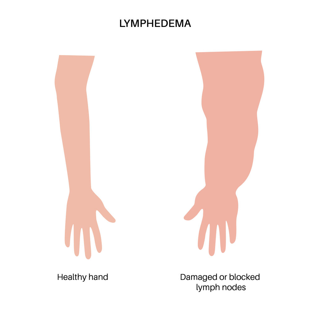 Lymphedema After Breast Cancer Frequency Incidence And What Increases Your Risk 