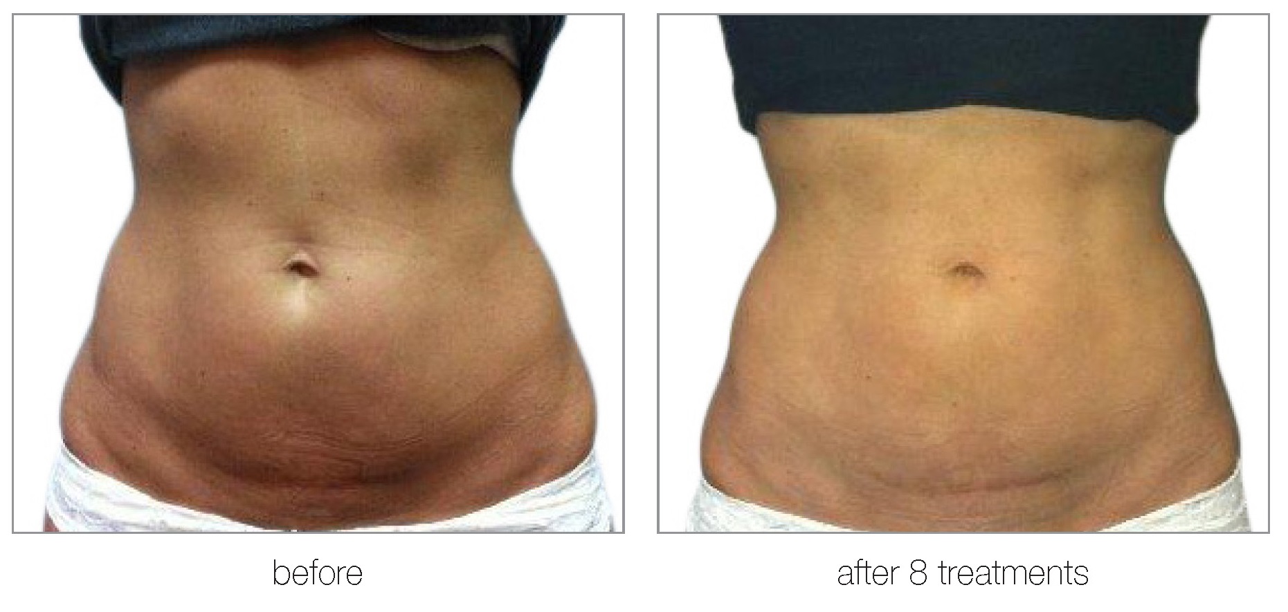 Venus Bliss Smooth - Non-Surgical Cellulite Reduction Treatment