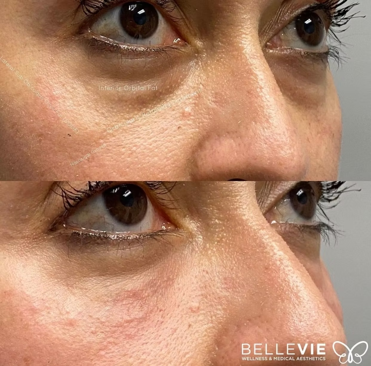 undereye fat removal undereye fat removal