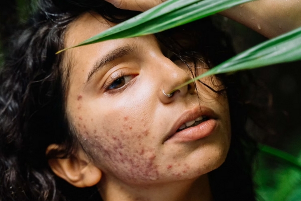 The Complete Guide To Treating Acne