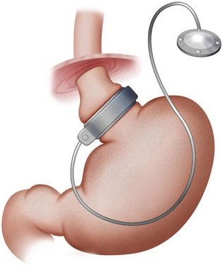Imagen de Banda Gástrica Ajustable