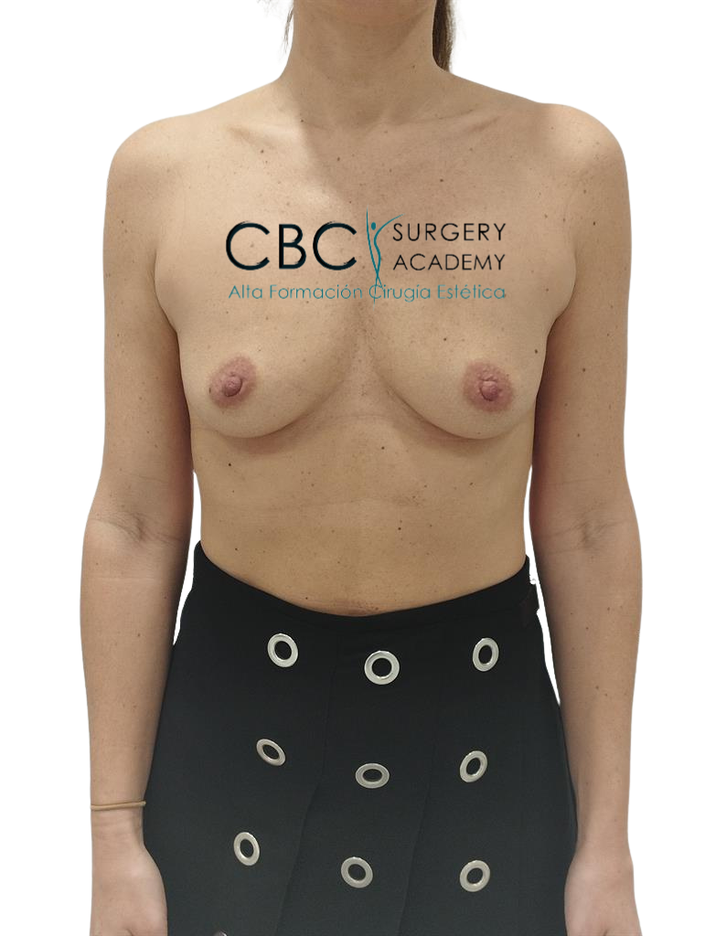 Ptosis mamaria antes de mastopexia periareolar con implantes Motiva ERSC 300Q