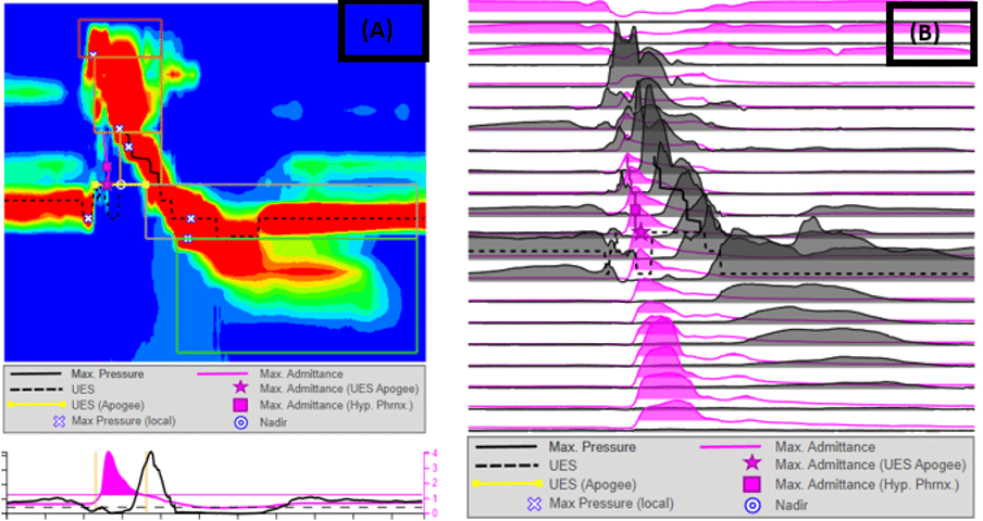 P-HRM-I – (A) High resolution manometry analysis of a pharyngeal swallow, via swallow gateway, demonstrating normal pharyngeal contractility and UOS relaxation with (B) pressure-impedance plot illustrating successful bolus passage and UOS opening measure via impedance. P-HRM-I – (A) High resolution manometry analysis of a pharyngeal swallow, via swallow gateway, demonstrating normal pharyngeal contractility and UOS relaxation with (B) pressure-impedance plot illustrating successful bolus passage and UOS opening measure via impedance.