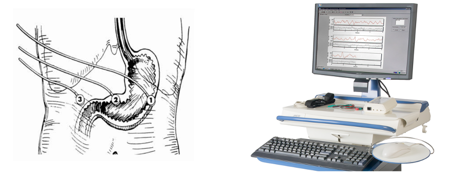 Shows a diagram of electrode placement for successful EGG recording. These electrodes are then attached to an isolated patient interface and the EGG signals are processed and displayed on a dedicated PC / Laptop. Shows a diagram of electrode placement for successful EGG recording. These electrodes are then attached to an isolated patient interface and the EGG signals are processed and displayed on a dedicated PC / Laptop.