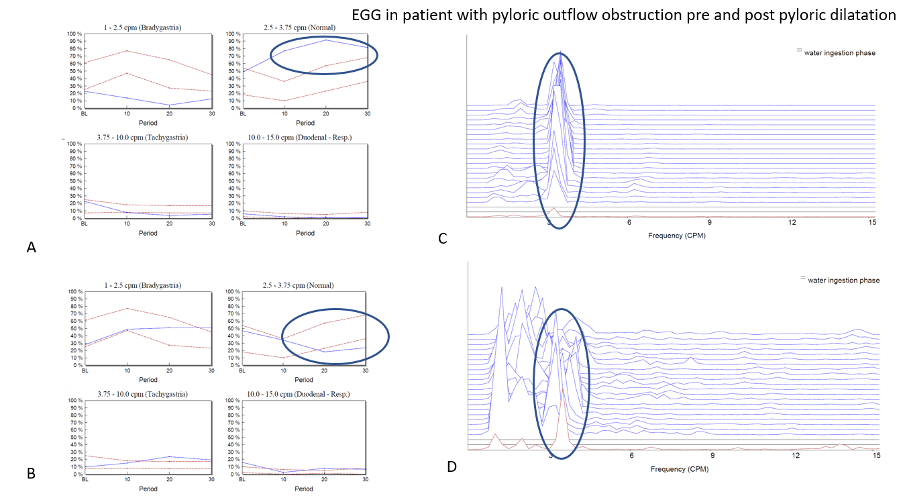 Panel A shows normative graphs for the four different frequency bands interrogated on the patient’s first visit. In this example it can be seen that at baseline, the normal 3cpm GMA is within the normal range but after the WLT this activity increases strongly to above the normal range indicating a hypernormal profile. This can be thought of as akin to a hypercontractile distal oesophageal contraction which is often observed when a patient has a degree of gastro-oesophageal outflow obstruction. This led to the patients having a pyloric dilatation and the study was repeated within 2-weeks of the procedure. The graphs seen in panel B shows that the patients EGG response to the WLT has now completely resolved as the pyloric outflow obstruction has been successfully treated. Panels C and D power spectral graphs of the EGG throughout the study at baseline (red) and following WLT (blue). Panel A shows normative graphs for the four different frequency bands interrogated on the patient’s first visit. In this example it can be seen that at baseline, the normal 3cpm GMA is within the normal range but after the WLT this activity increases strongly to above the normal range indicating a hypernormal profile. This can be thought of as akin to a hypercontractile distal oesophageal contraction which is often observed when a patient has a degree of gastro-oesophageal outflow obstruction. This led to the patients having a pyloric dilatation and the study was repeated within 2-weeks of the procedure. The graphs seen in panel B shows that the patients EGG response to the WLT has now completely resolved as the pyloric outflow obstruction has been successfully treated. Panels C and D power spectral graphs of the EGG throughout the study at baseline (red) and following WLT (blue).