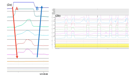 SGB identifiable on 24 hours pH/impedance monitoring, characterised by sucking in air (A) and expelling it quickly from the oesophagus (B). Figure 2b (above) – repetitive SGB. SGB identifiable on 24 hours pH/impedance monitoring, characterised by sucking in air (A) and expelling it quickly from the oesophagus (B). Figure 2b (above) – repetitive SGB.