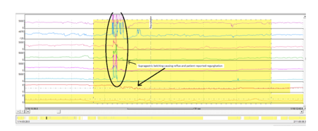 Acidic reflux episode and patient-reported regurgitation preceded by SGB. Acidic reflux episode and patient-reported regurgitation preceded by SGB.