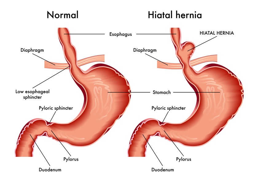 What Is Hiatal Hernia: Causes, Symptoms, and Treatment