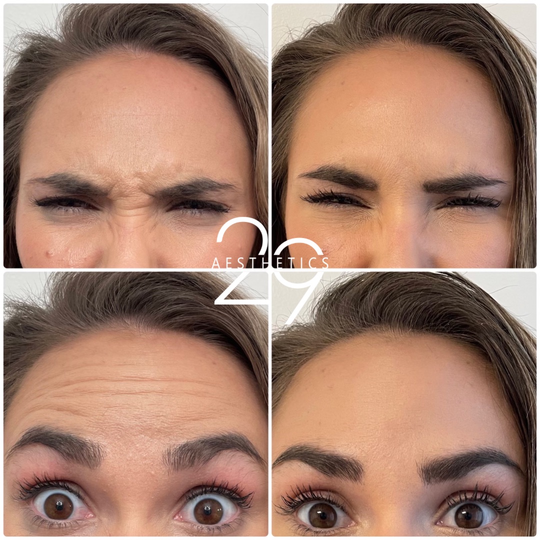 Neurotoxin treatment results. Wrinkle treatment before and after forehead and eyes.
