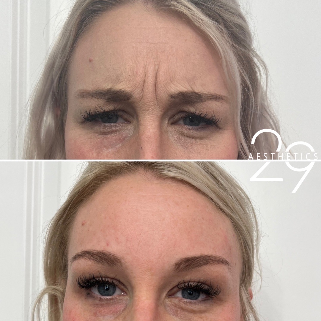 Before and after frown line wrinkle treatment. Before and after frown line wrinkle treatment.