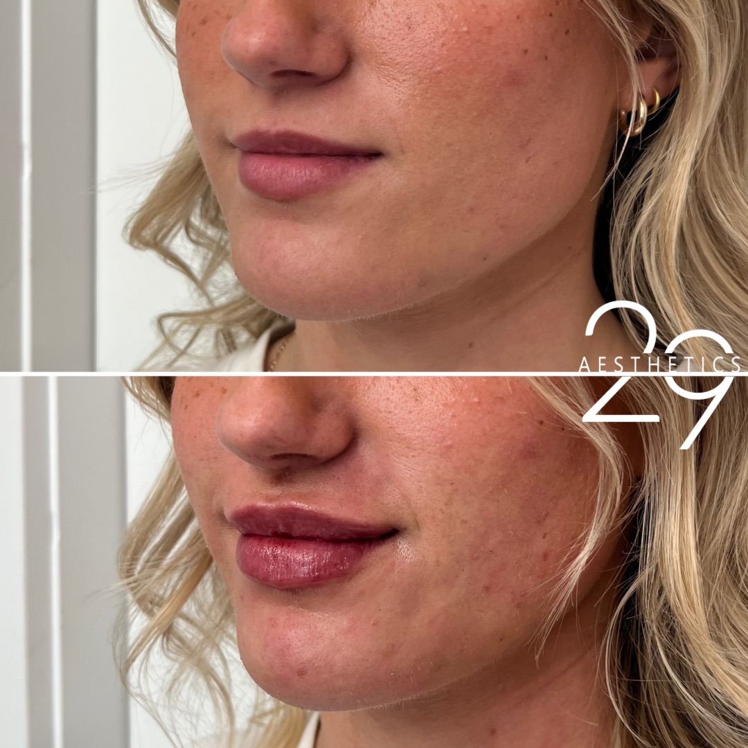 Lip filler before and after images at 29 Aesthetics 