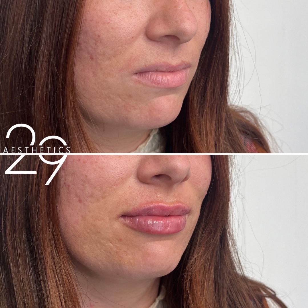 Lip filler before and after images at 29 Aesthetics 