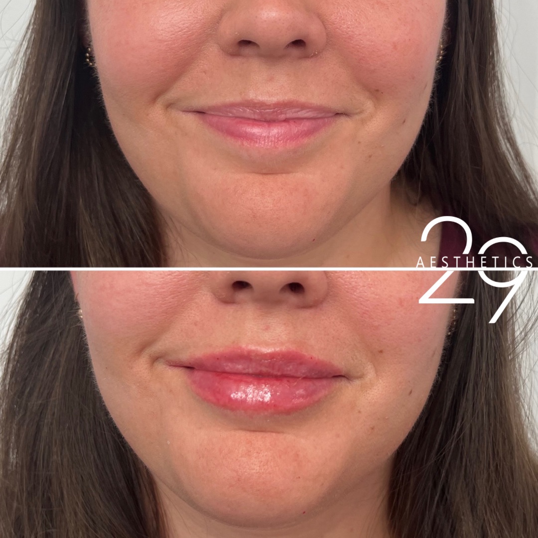 Lip filler before and after images at 29 Aesthetics 