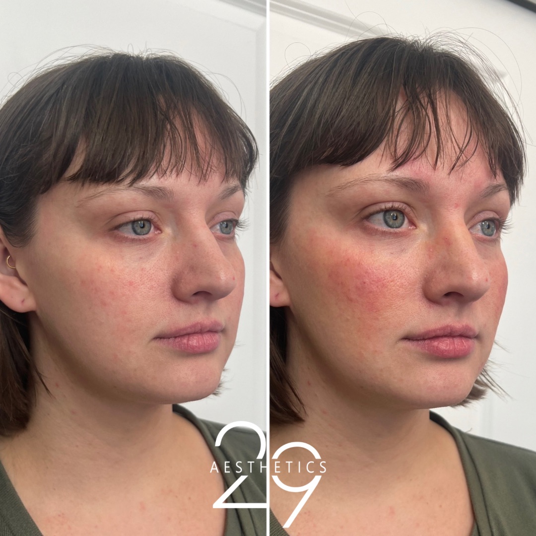 Cheek filler before and after comparison on woman. 