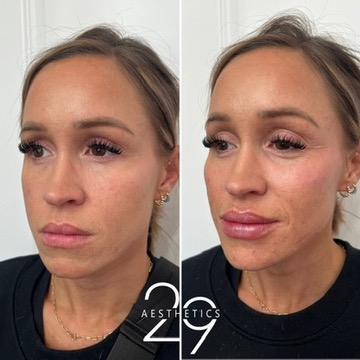 Cheek filler before and after comparison on woman. 