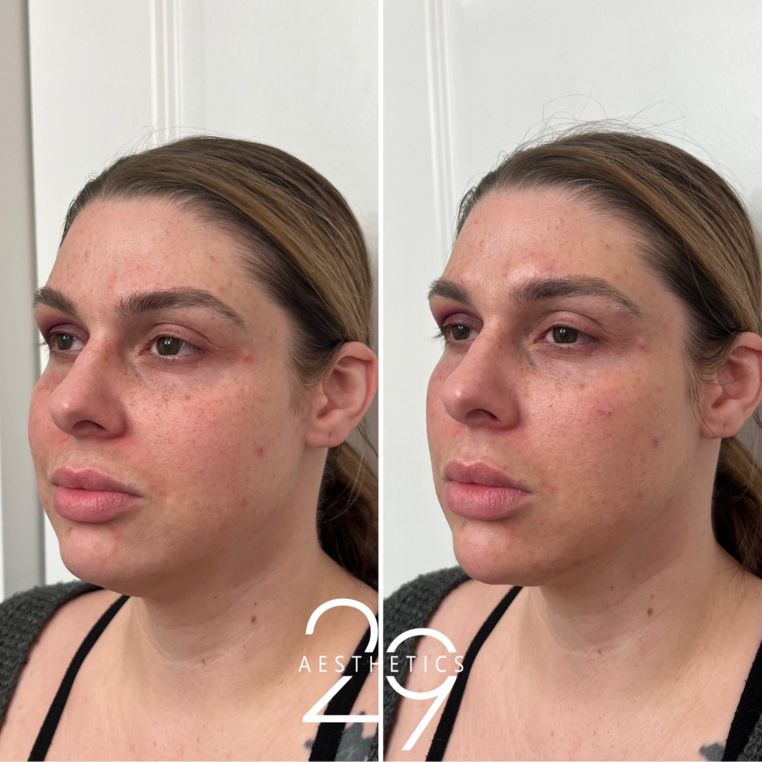 Chin filler before and after comparison photo of woman.