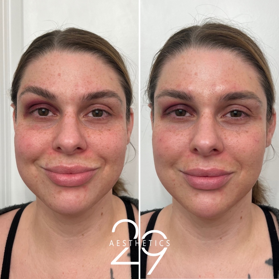 Chin filler before and after comparison photo of woman.